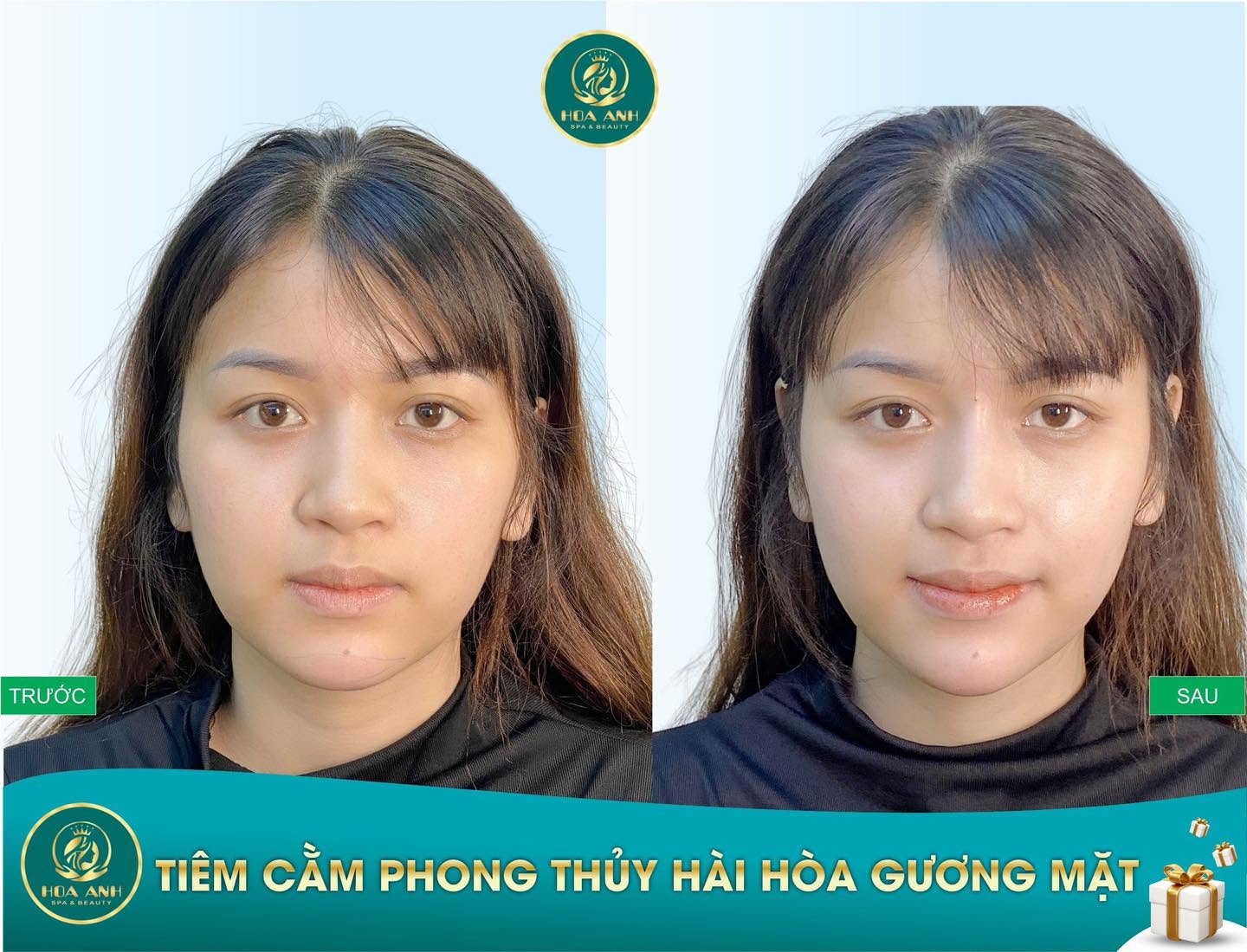 Trước và sau tiêm Filler cằm phong thủy tại Hoa Anh